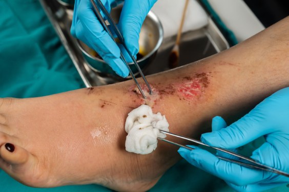 Wound Care in the Field: Irrigation, Dressing, Topical Antibiotics and Penicillin Allergies.